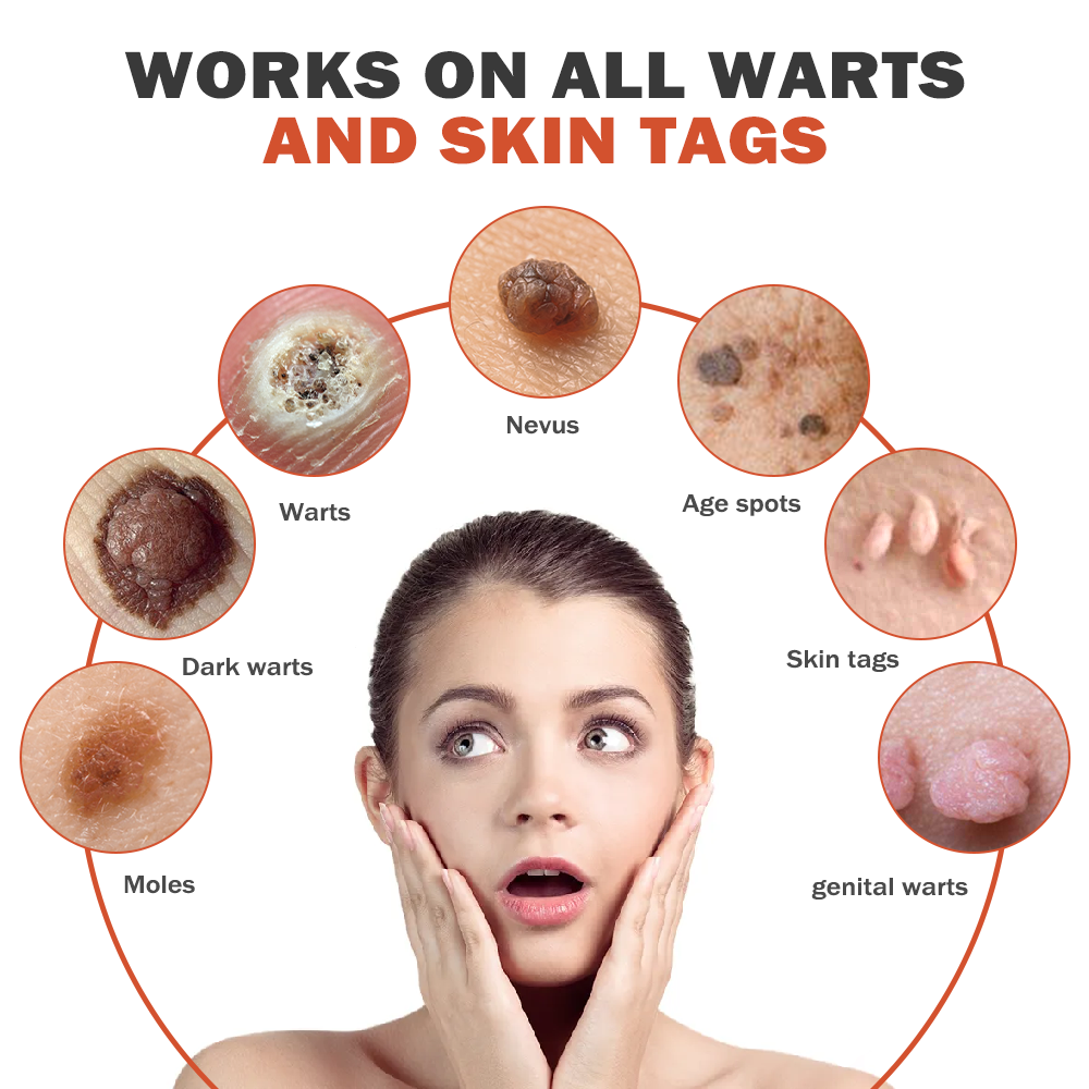 𝐁𝐞𝐞 𝐕𝐞𝐧𝐨𝐦 𝐌𝐨𝐥𝐞 𝐚𝐧𝐝 𝐖𝐚𝐫𝐭 𝐓𝐫𝐞𝐚𝐭𝐦𝐞𝐧𝐭 𝐂𝐫𝐞𝐚𝐦(👨‍⚕𝐀𝐀𝐃 𝐑𝐄𝐂𝐎𝐌𝐌𝐄𝐍𝐃𝐒)