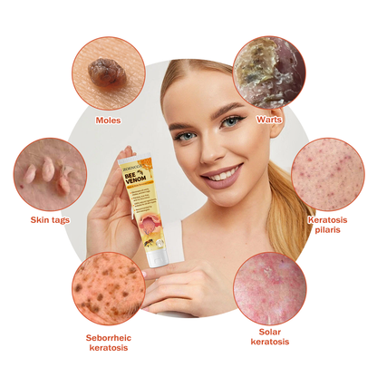 𝐙𝐨𝐞𝐧𝐜𝐠𝐳™ 𝐁𝐞𝐞 𝐕𝐞𝐧𝐨𝐦 𝐌𝐨𝐥𝐞 𝐚𝐧𝐝 𝐖𝐚𝐫𝐭 𝐓𝐫𝐞𝐚𝐭𝐦𝐞𝐧𝐭 𝐂𝐫𝐞𝐚𝐦(👨‍⚕𝐀𝐀𝐃 𝐑𝐄𝐂𝐎𝐌𝐌𝐄𝐍𝐃𝐒)