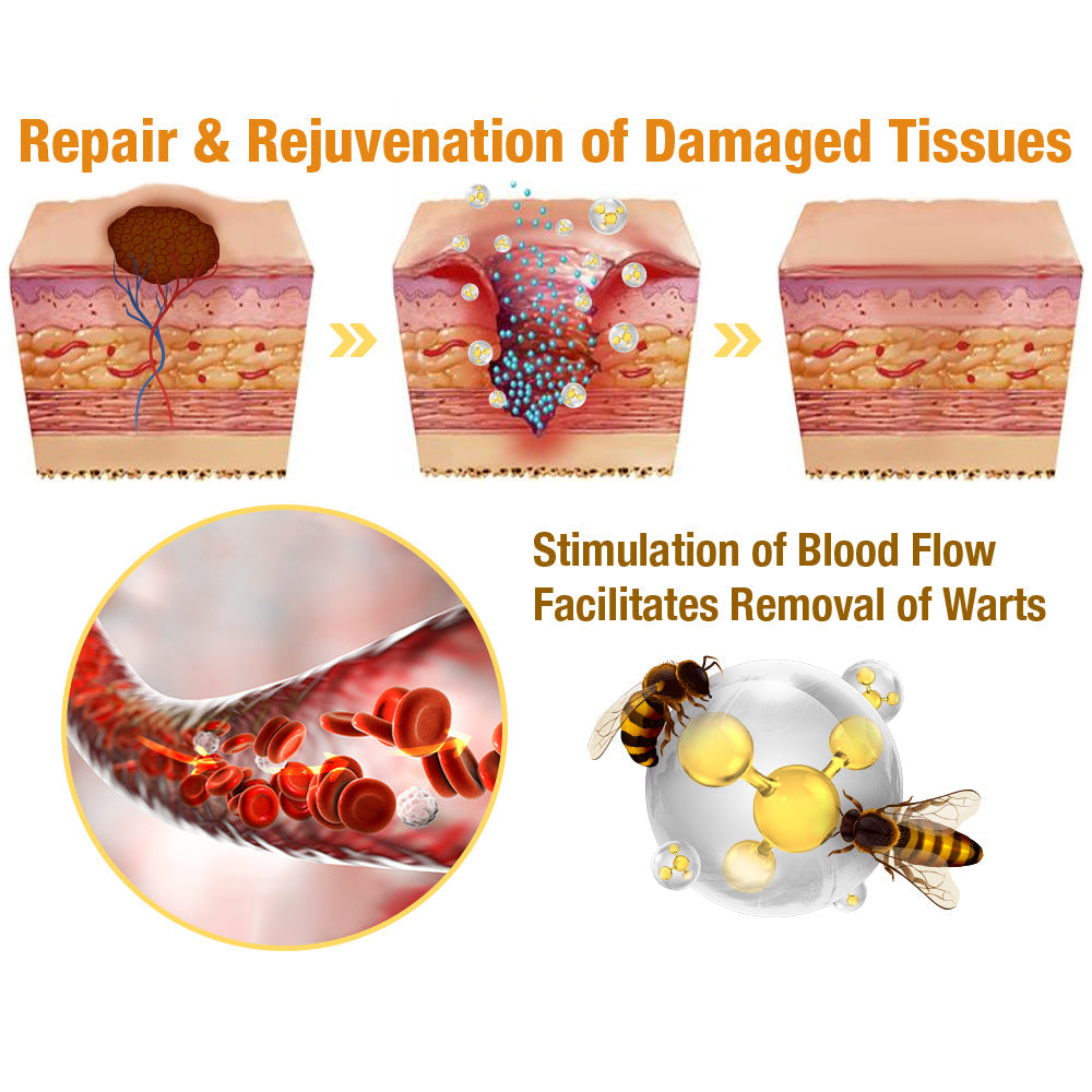 𝐁𝐞𝐞 𝐕𝐞𝐧𝐨𝐦 𝐌𝐨𝐥𝐞 𝐚𝐧𝐝 𝐖𝐚𝐫𝐭 𝐓𝐫𝐞𝐚𝐭𝐦𝐞𝐧𝐭 𝐂𝐫𝐞𝐚𝐦(👨‍⚕𝐀𝐀𝐃 𝐑𝐄𝐂𝐎𝐌𝐌𝐄𝐍𝐃𝐒)